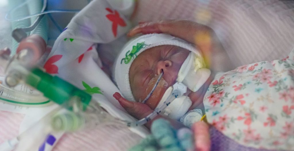 baby Margot unexpectedly arrived 17 weeks premature